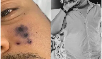 Cantor morto após ser picado por aranha