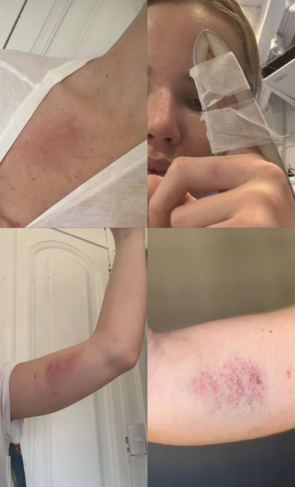 Suposta agressão sofrida por Miss Gramado Marcela Tomaszewski