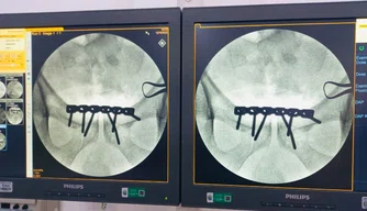 Hospital Regional de Piripiri realiza cirurgia de fratura da bacia