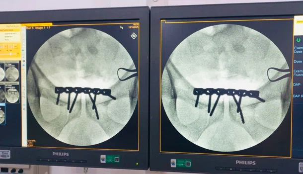 Hospital Regional de Piripiri realiza cirurgia de fratura da bacia