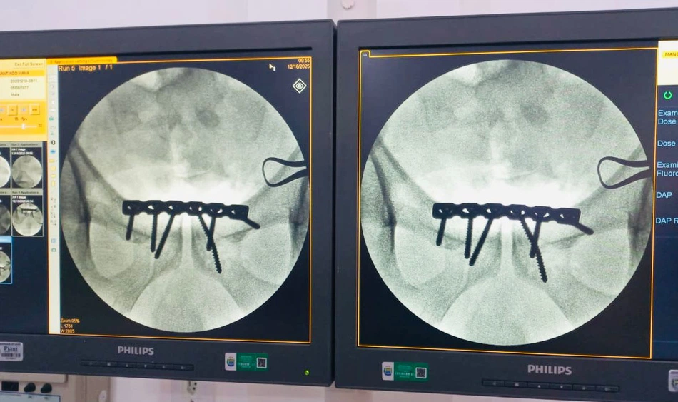 Hospital Regional de Piripiri realiza cirurgia de fratura da bacia